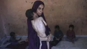 potret anak anak malnutrisi korban kelaparan di gaza 1753328471990 169